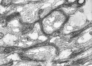 M,15y. | neurinoma n. optici